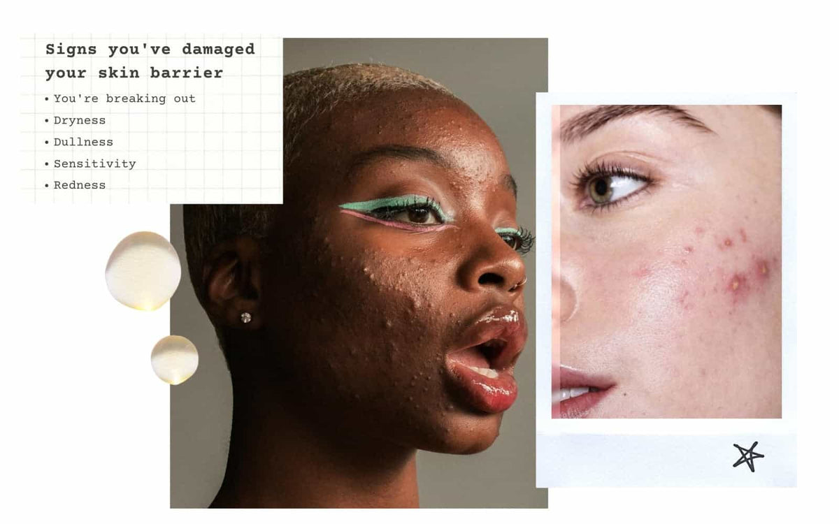 Sensitive Skin Barrier Damaged Signs: Top Warning Symptoms Revealed